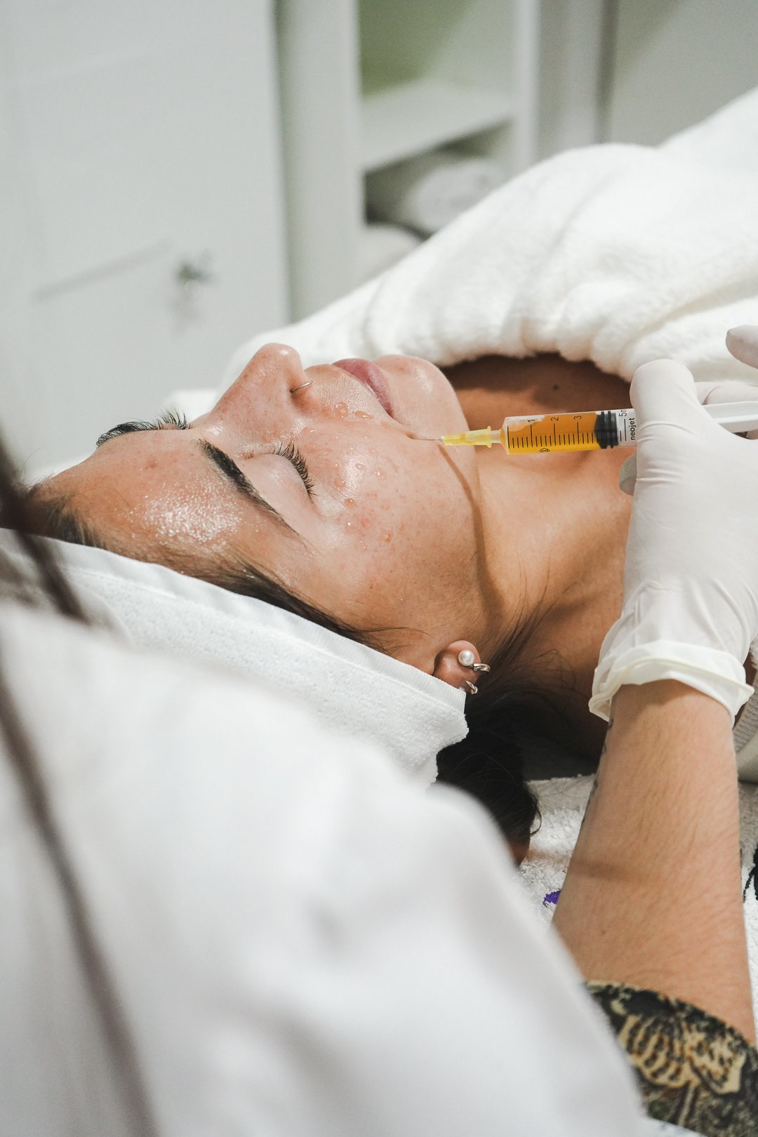 Aplicación inyectable en rostro