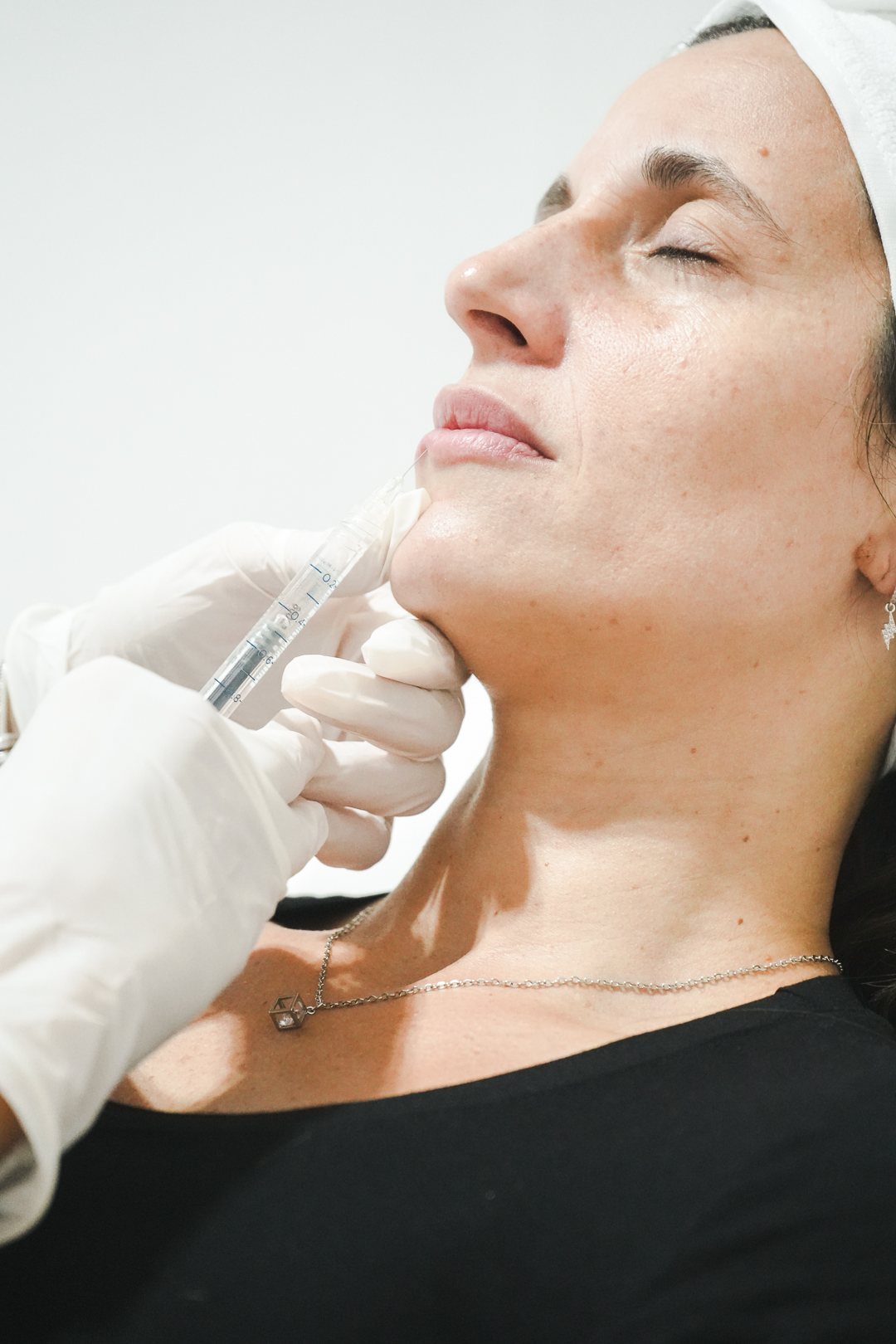 Aplicación de relleno de labios