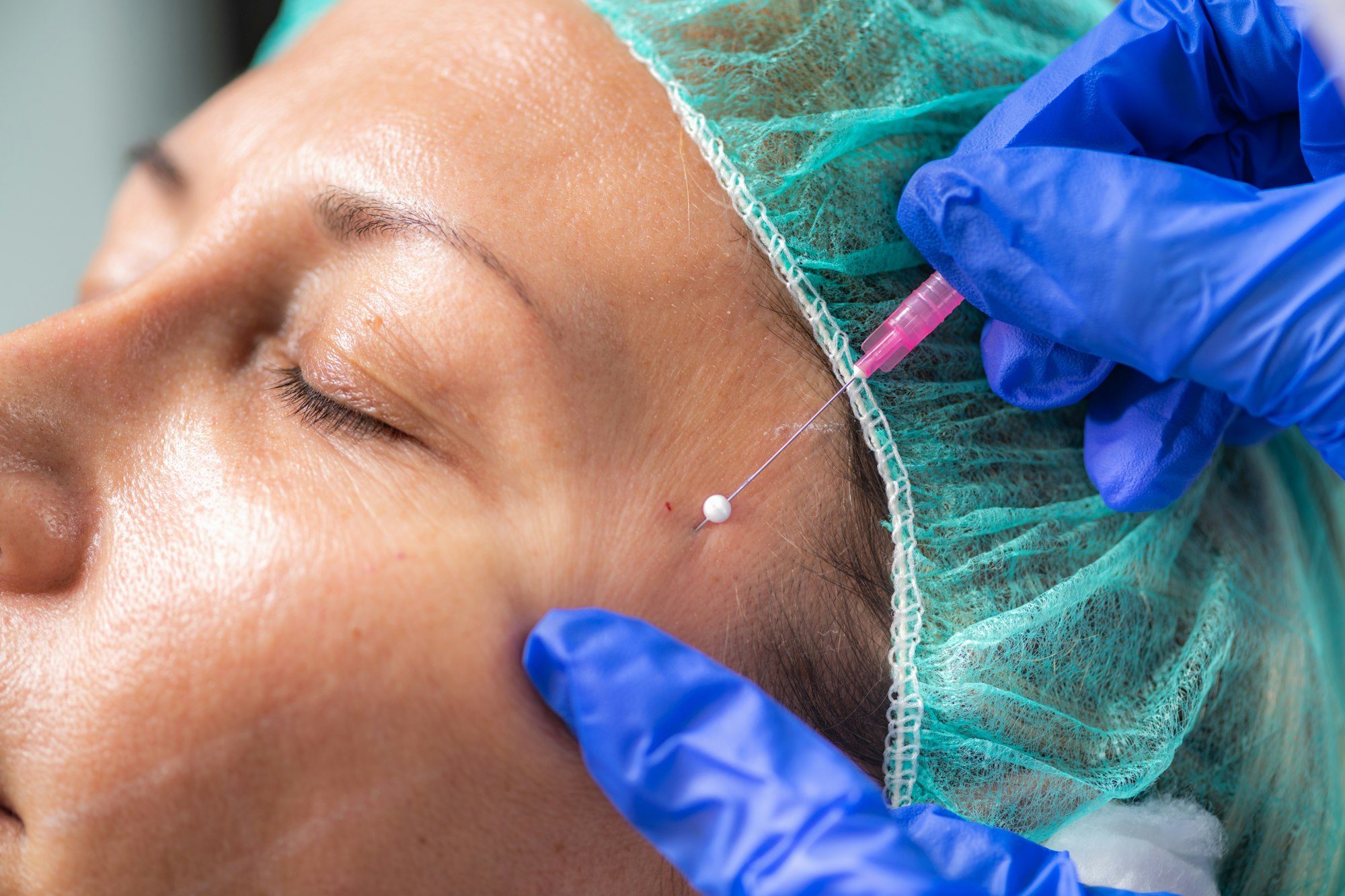 Marcación facial previa a un tratamiento (imagen ilustrativa)